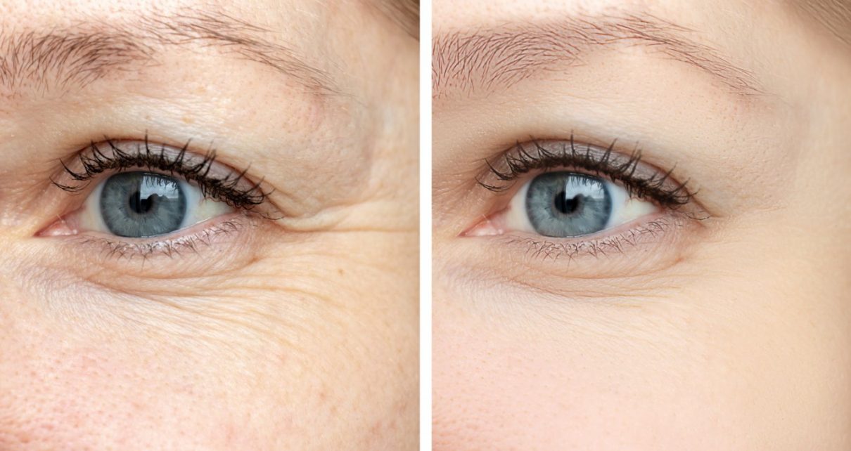 fine lines and wrinkles