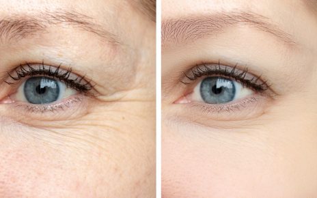 fine lines and wrinkles