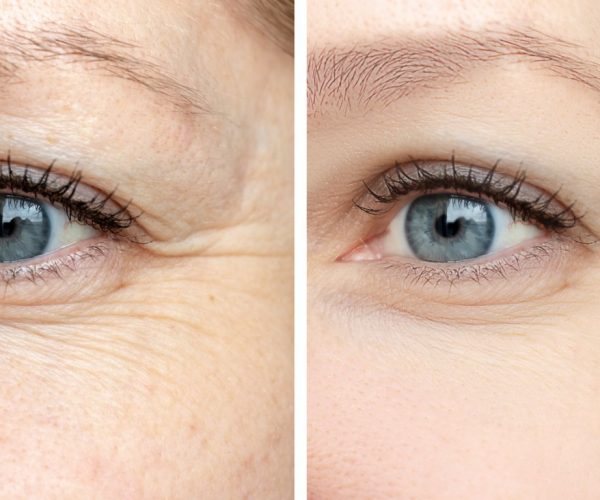 fine lines and wrinkles