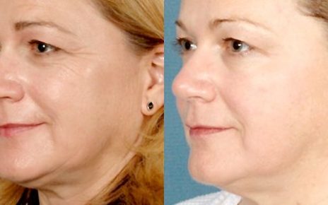 facelift manchester